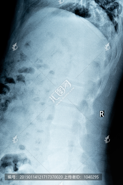 腰椎轻度骨质增生的X光片