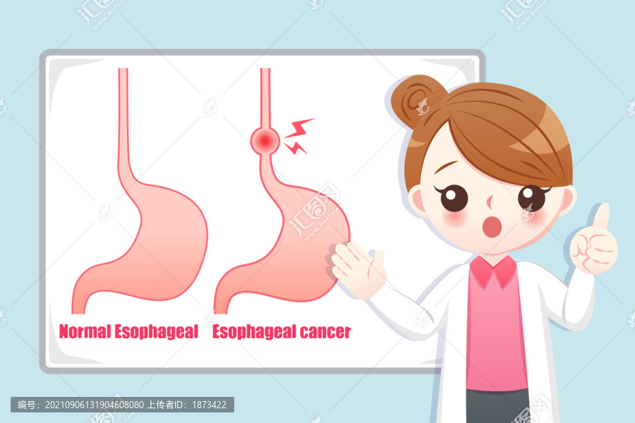 食道癌示意设计插图