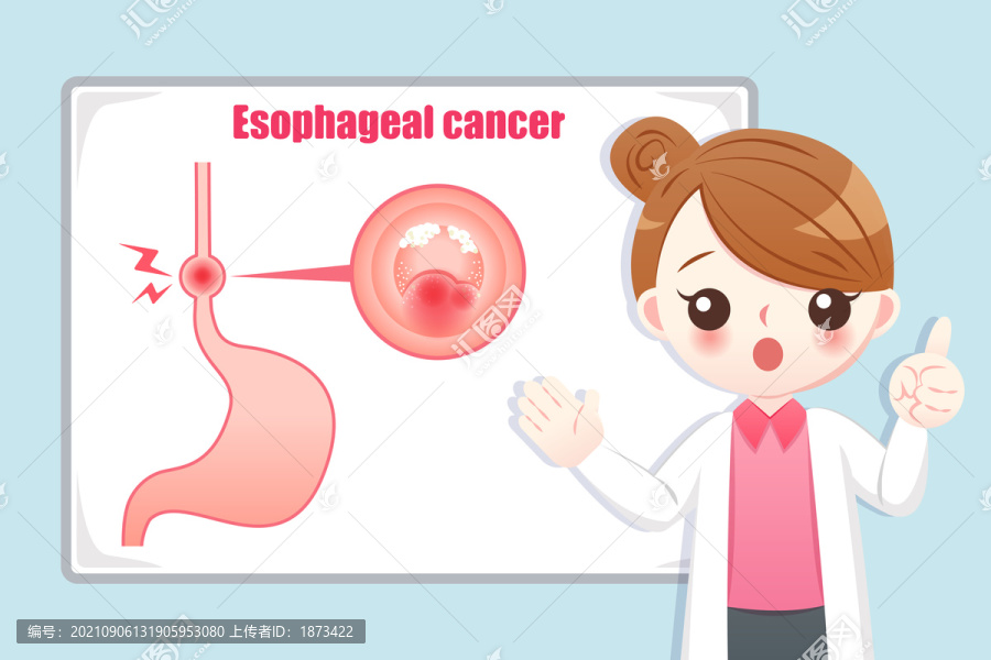 食道癌示意设计插图