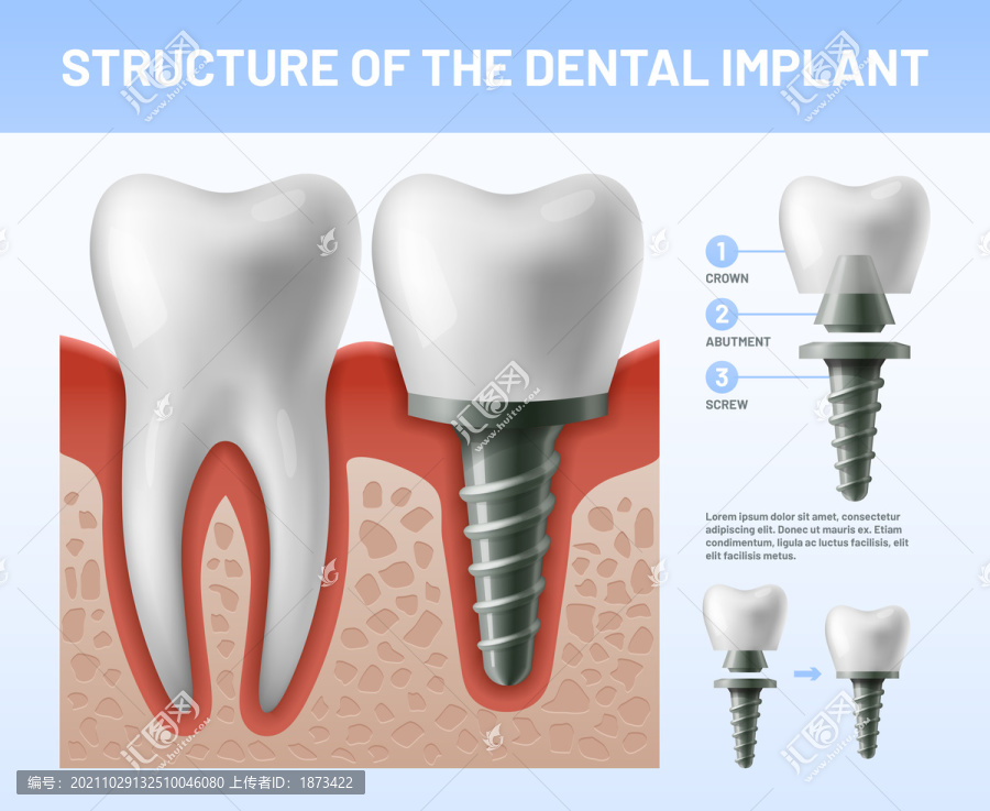 牙齿种植结构介绍海报