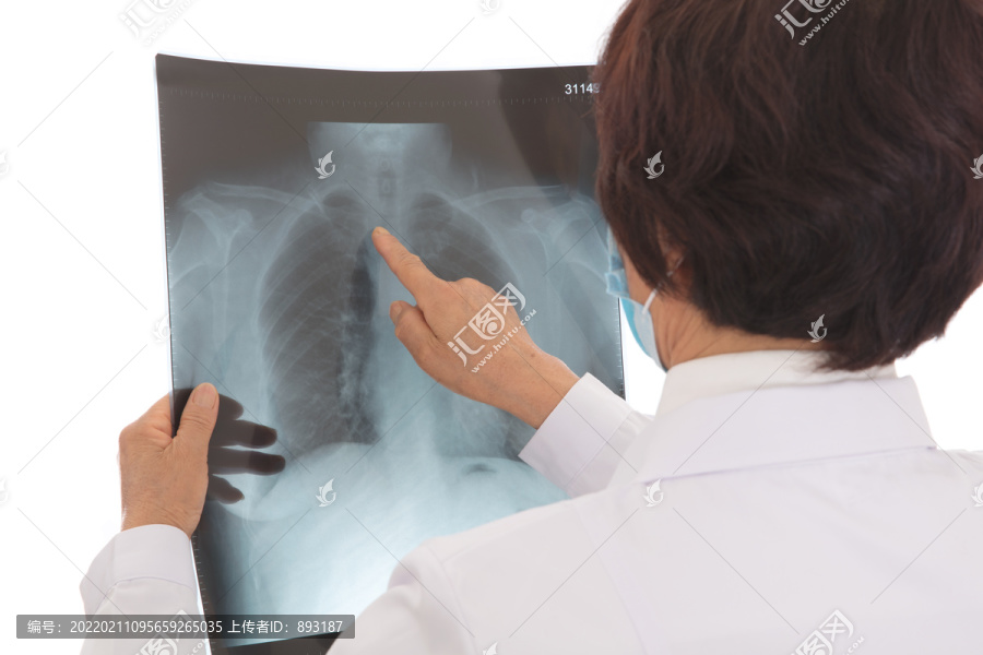 女医生在认真的查看肺部X光片