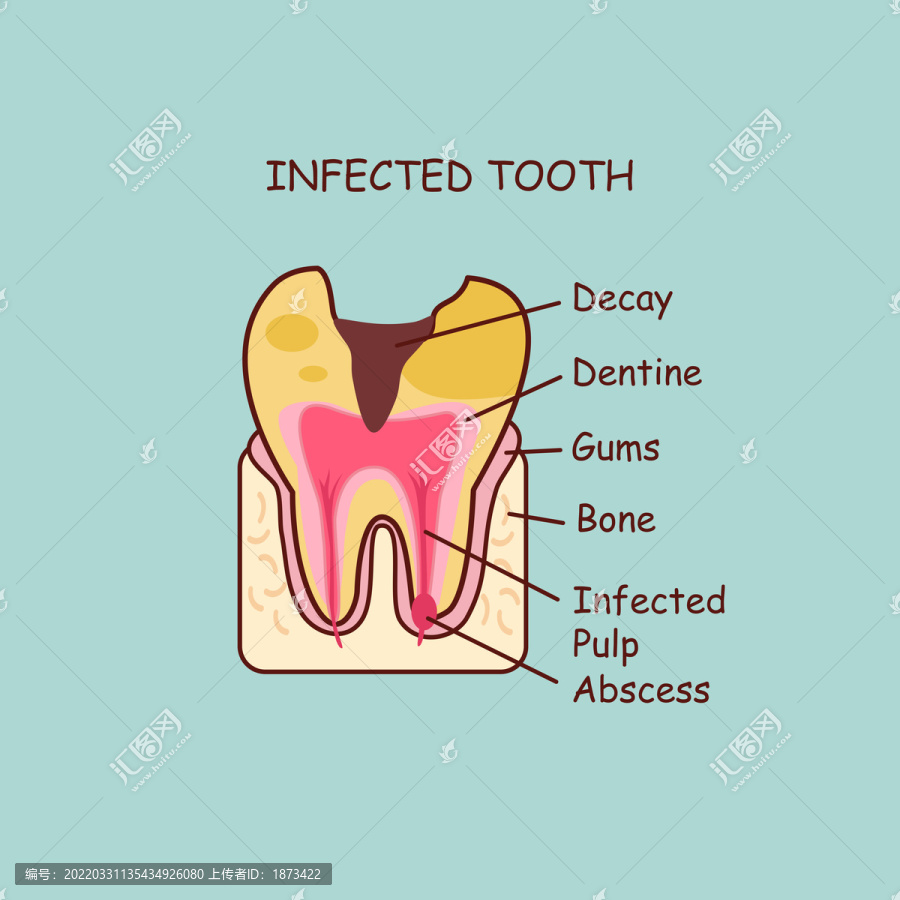 感染病变牙齿剖面插图