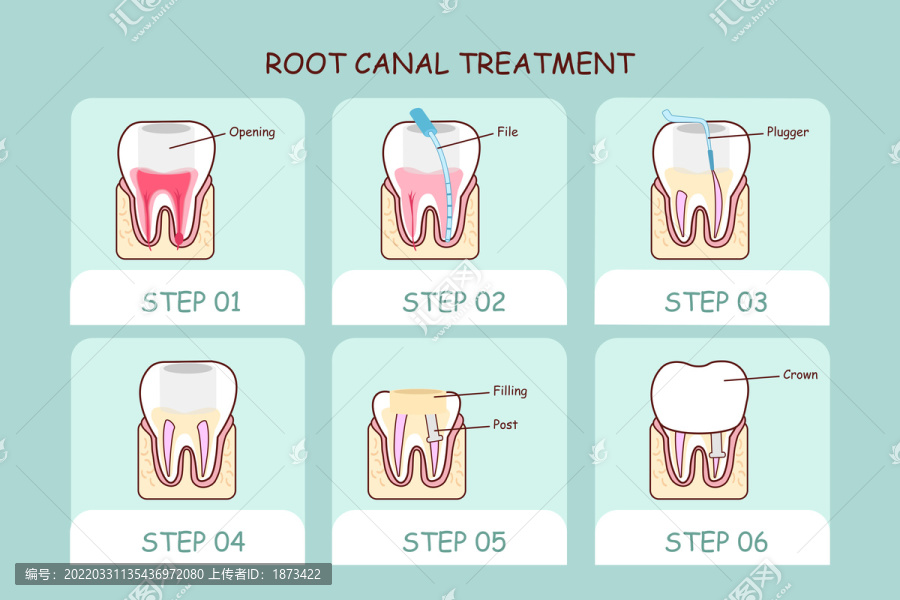 牙齿根管治疗步骤插图
