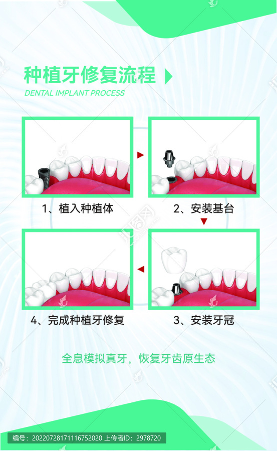 种植牙修复流程医院装修展板